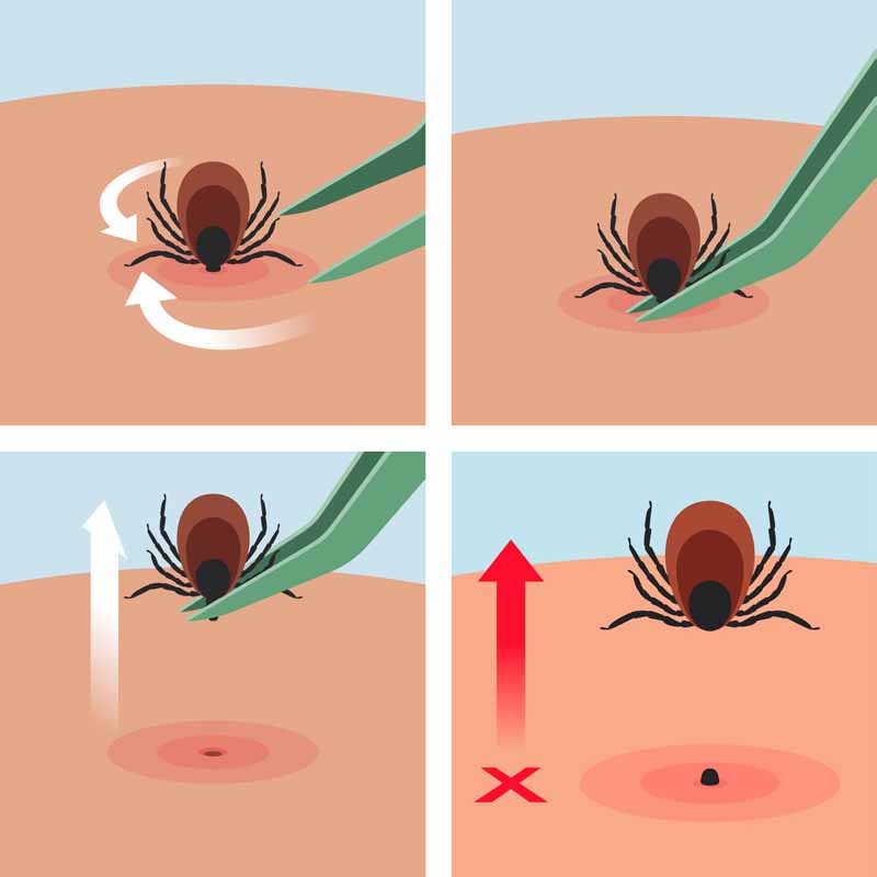 Zecken und Wandern – Borreliose und FSME – Wie kann man das Risiko von Zeckenstichen auf Wanderungen vermeiden und Erkrankungen vorbeugen?